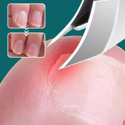 Adiós a las Uñas Encarnadas. ¡Corte Preciso y Seguro!